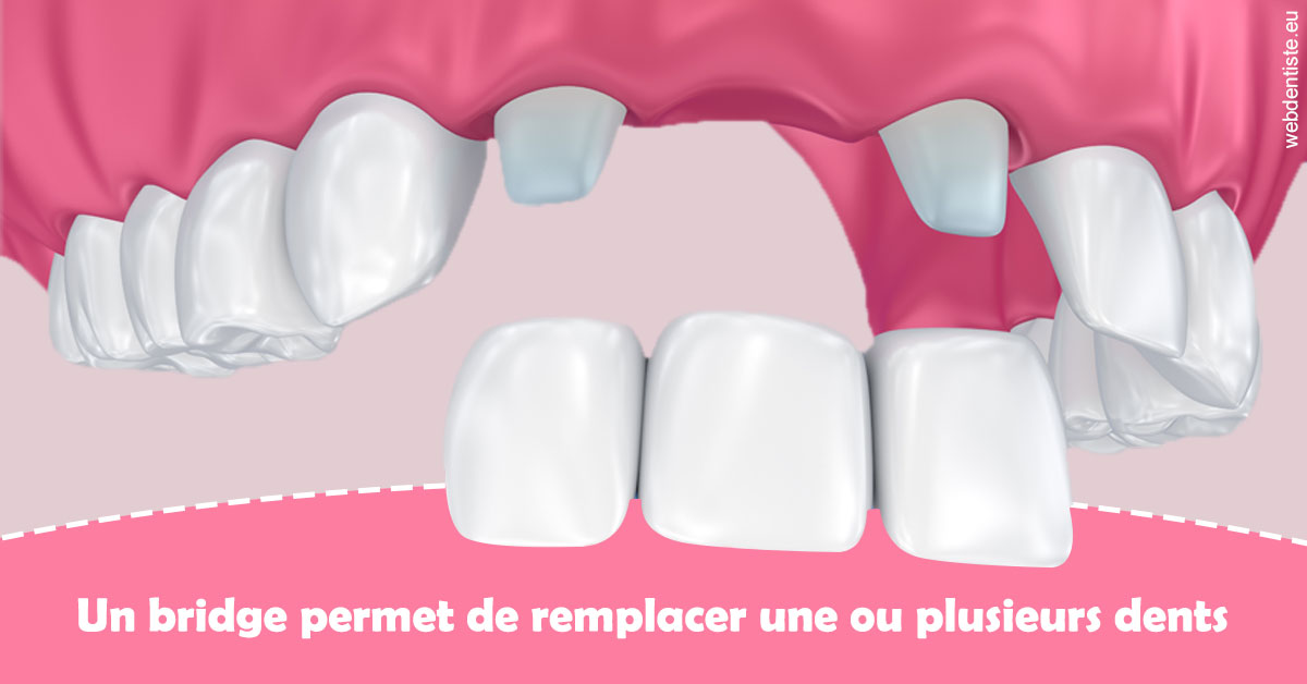 https://dr-dondoglio-virginie.chirurgiens-dentistes.fr/Bridge remplacer dents 2