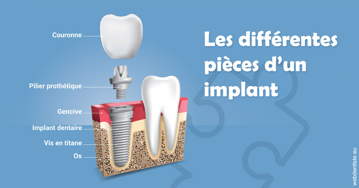 https://dr-dondoglio-virginie.chirurgiens-dentistes.fr/Les différentes pièces d’un implant 1